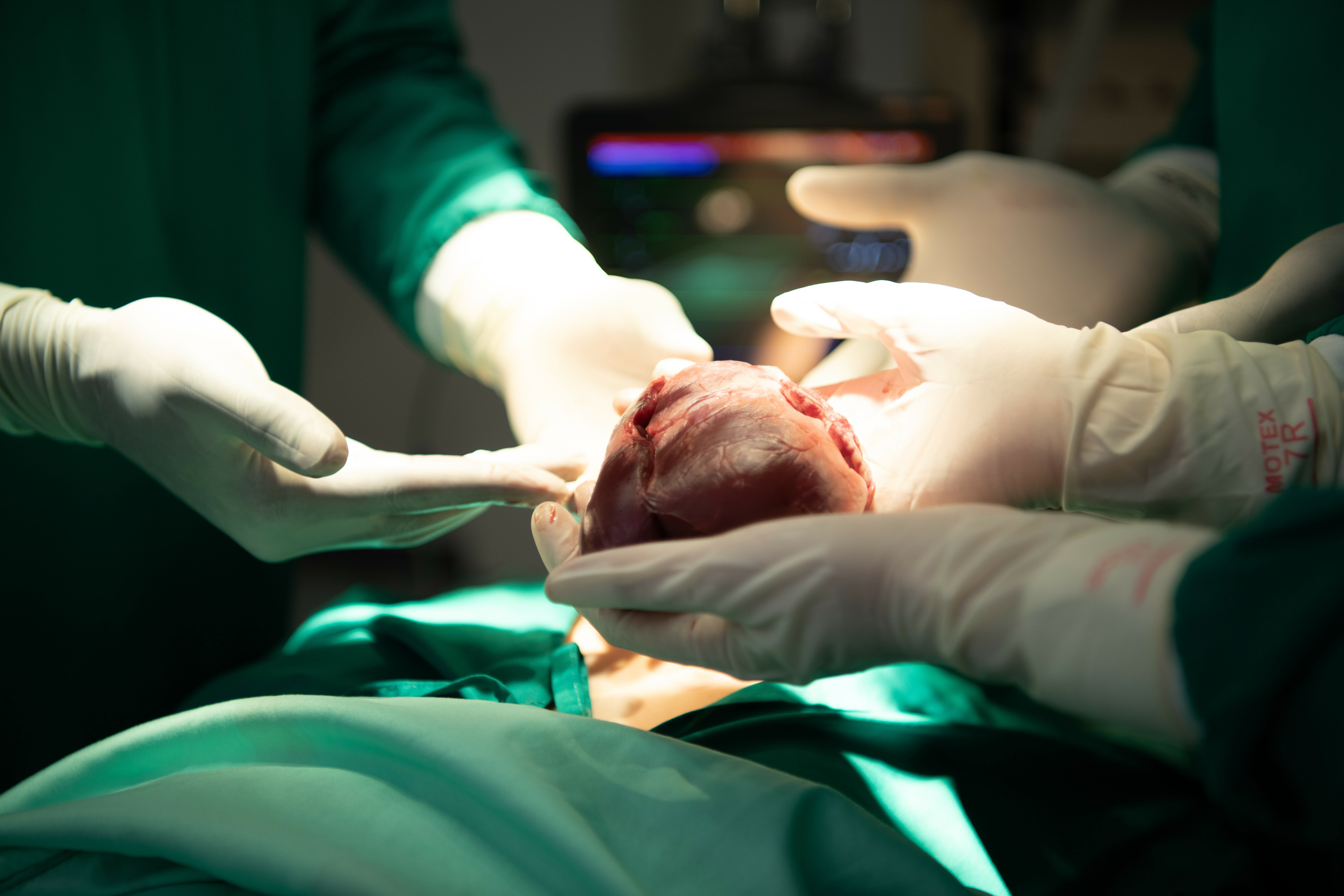 Read more about the article Flertal støtter ikke automatisk organdonation: Går for langt